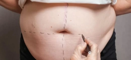 abdominoplastia