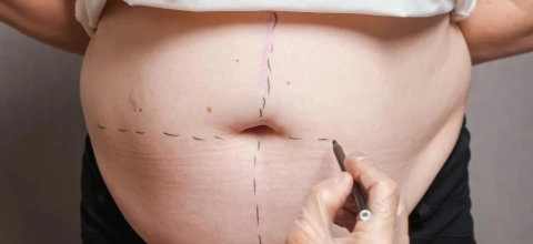 abdominoplastia